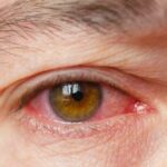 glaucome par fermeture de l angle
