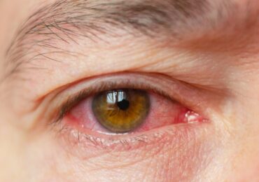 glaucome par fermeture de l angle