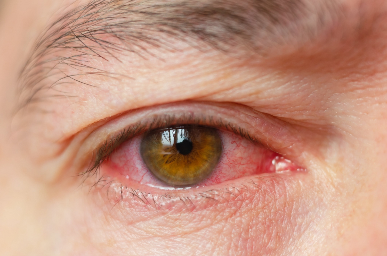 glaucome par fermeture de l angle