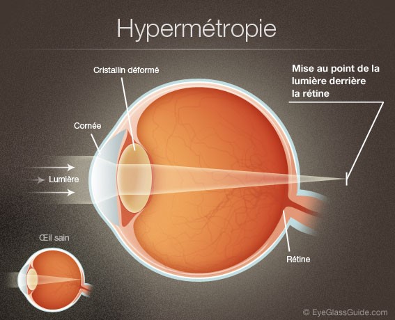 les maladies ophtalmologiques des yeux hypermetropie 01
